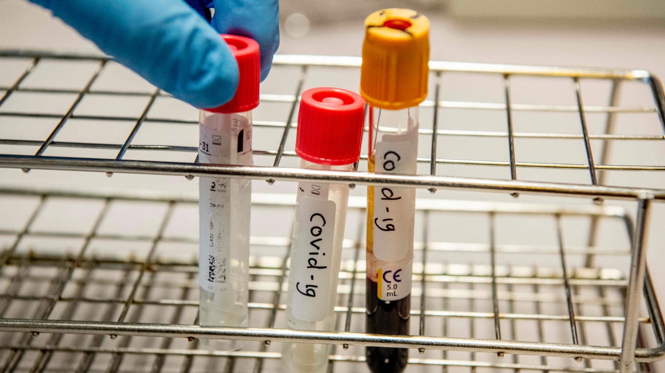 Proben, die auf die Viruserkrankung Covid-19 getestet wurden: In einem Labor im Kreis Ravensburg sind fast 2.000 Proben liegengeblieben, weil die nötigen Chemikalien gefehlt haben. Viele sind nun unbrauchbar. (Symbolfoto)