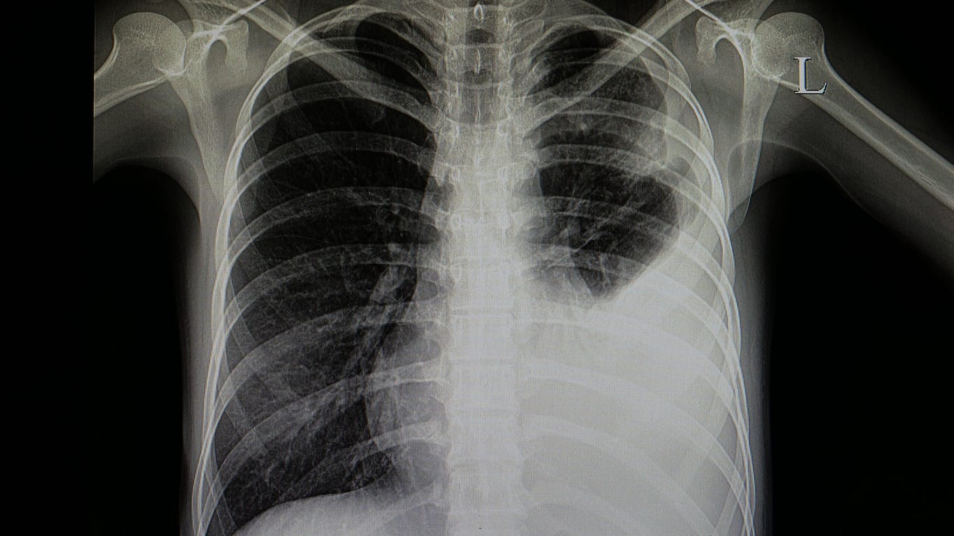 Röntgenbild eines Patienten mit Lungenentzündung: Wer an Pneumonie leidet, dem droht ein schwererer Verlauf von Covid-19.