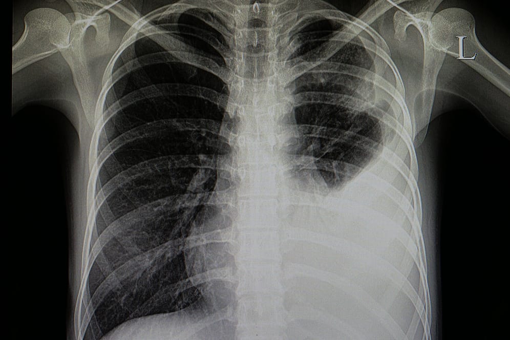 Röntgenbild eines Patienten mit Lungenentzündung: Wer an Pneumonie leidet, dem droht ein schwererer Verlauf von Covid-19.