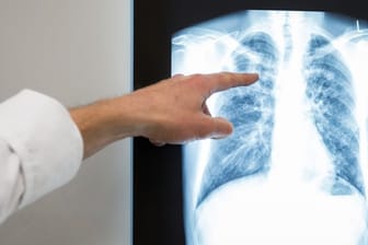 Für TB-Patienten ist eine Ansteckung mit dem neuen Virus, das die Lungenkrankheit Covid-19 auslöst, besonders gefährlich.