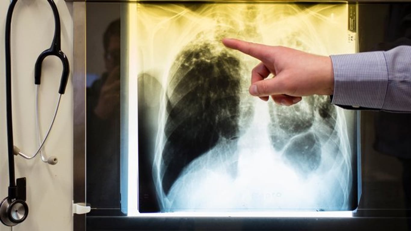 Ein Arzt zeigt einen Tuberkulose-Fall anhand eines Röntgenbildes in seinem Büro im Tuberkulosezentrum Berlin.