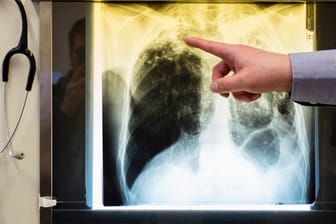 Ein Arzt zeigt einen Tuberkulose-Fall anhand eines Röntgenbildes in seinem Büro im Tuberkulosezentrum Berlin.