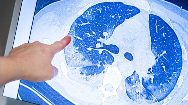 Ein behandelnder Arzt zeigt auf die CT-Aufnahme der Lunge eines Patienten, der sich mit dem Coronavirus infiziert hat. Ein behandelnder Arzt zeigt auf die CT-Aufnahme der Lunge eines Patienten, der sich mit dem Coronavirus infiziert hat.