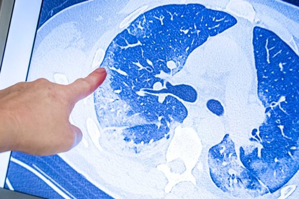 Ein behandelnder Arzt zeigt auf die CT-Aufnahme der Lunge eines Patienten, der sich mit dem Coronavirus infiziert hat.