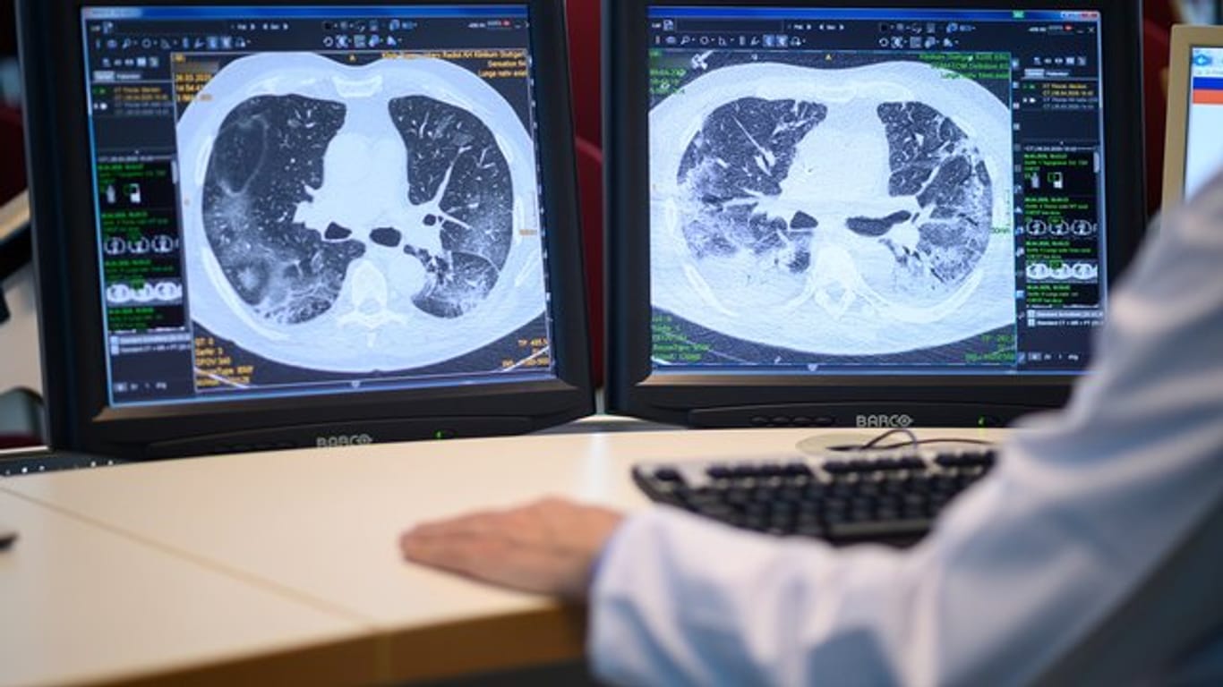 Computertomographieaufnahmen zeigen die Lunge eines Covid-19-Patienten.
