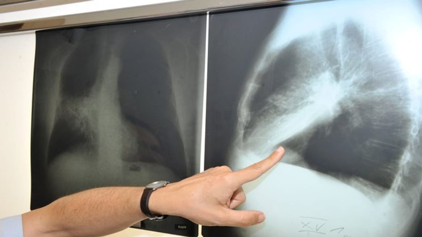 Ein Röntgenbild von einer von Krebs befallenen Lunge.