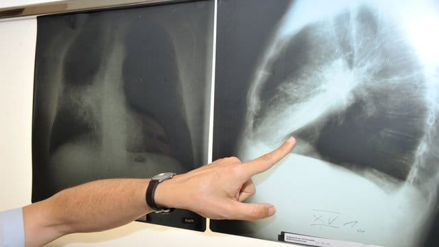 Die Krebssterblichkeit hat in den vergangenen Jahren innerhalb der EU weiter abgenommen. Die Krebssterblichkeit hat in den vergangenen Jahren innerhalb der EU weiter abgenommen.