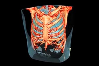 Welche sichtbaren Schäden Covid-19 in der Lunge anrichtet, zeigen CT-Aufnahmen.