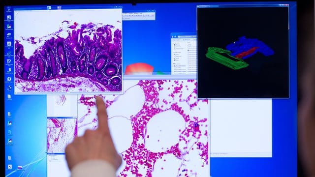 Das zu Vergrößerung eingesetzte "virtuelle Mikroskop" ermöglicht den internationalen Austausch von Befunden bei der Krebs-Diagnostik in der Pathologie. Das zu Vergrößerung eingesetzte "virtuelle Mikroskop" ermöglicht den internationalen Austausch von Befunden bei der Krebs-Diagnostik in der Pathologie.