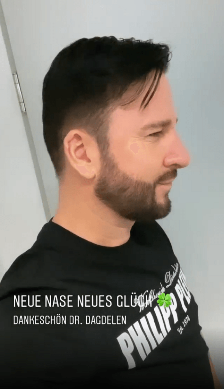Michael Wendler: Der Sänger hat sich die Nase operieren lassen.