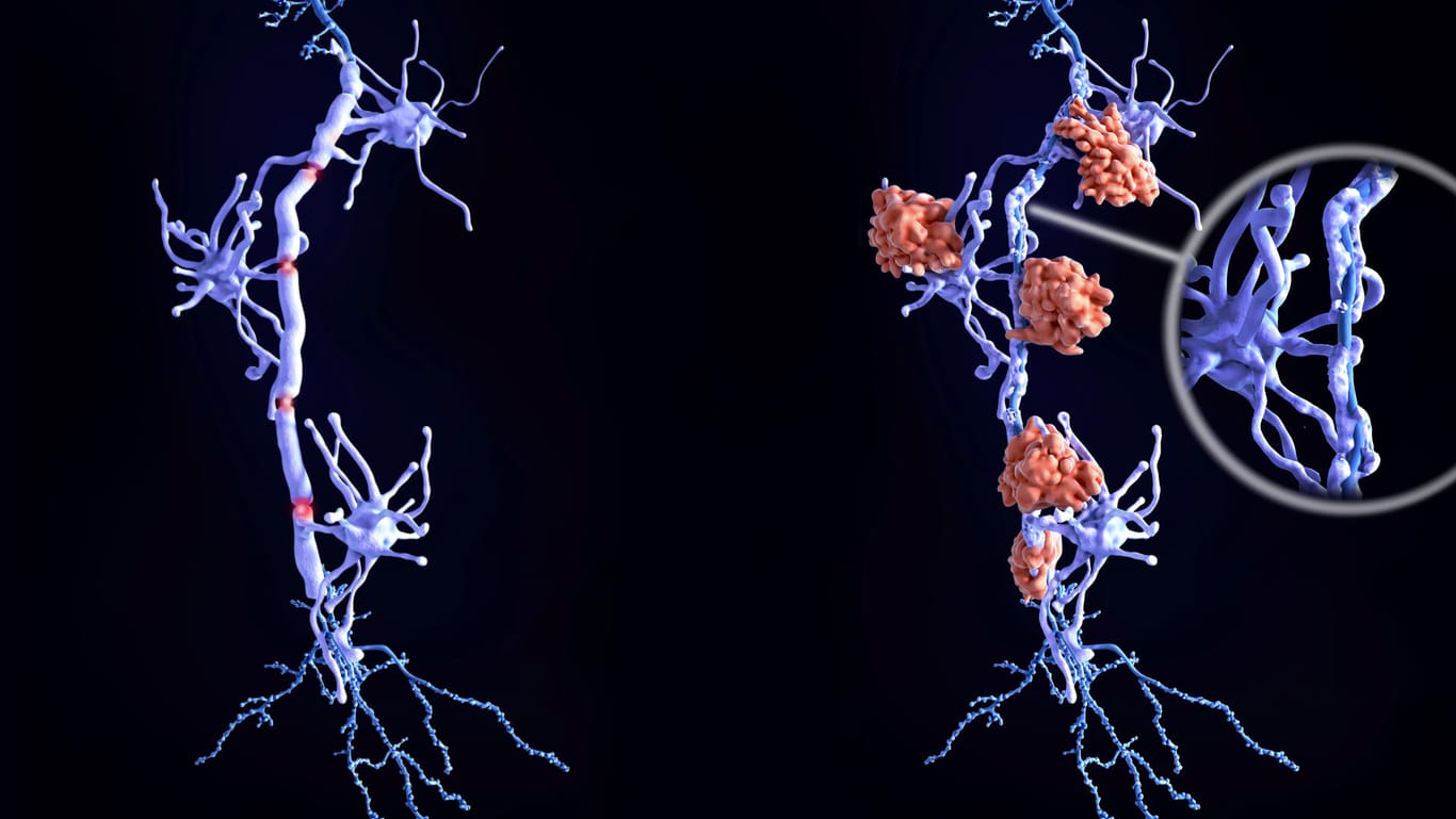 Grafische Darstellung von Nervenzellen im Gehirn: Bei Multipler Sklerose wird die Myelinschicht geschädigt (rechts), die die Nervenzellen umgibt und schützt. Bei einer gesunden Nervenzelle (links) ist sie dagegen intakt.