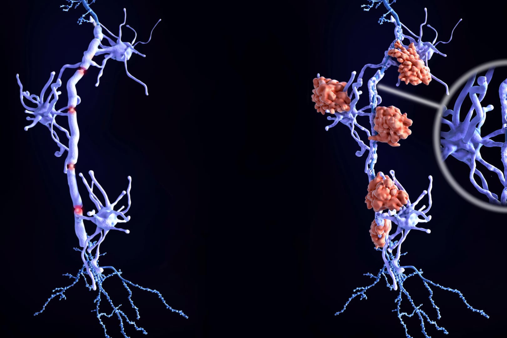 Grafische Darstellung von Nervenzellen im Gehirn: Bei Multipler Sklerose wird die Myelinschicht geschädigt (rechts), die die Nervenzellen umgibt und schützt. Bei einer gesunden Nervenzelle (links) ist sie dagegen intakt.