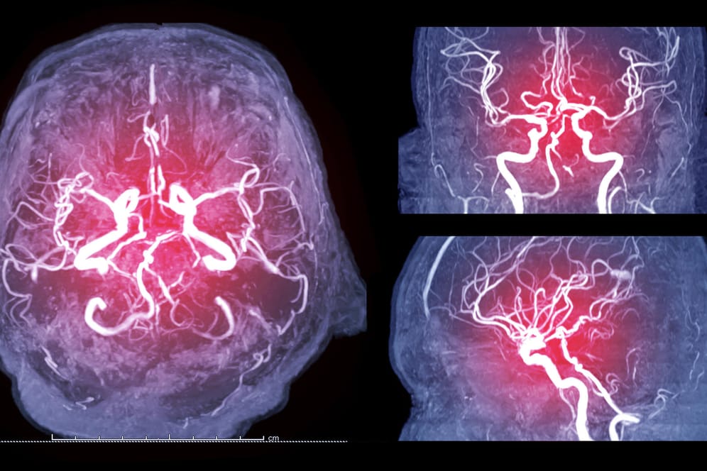 Aufnahmen des Gehirns: Unter den schweren Covid-19-Verläufen seien laut Experten häufig vorerkrankte Menschen, etwa mit Diabetes und hohem Blutdruck.