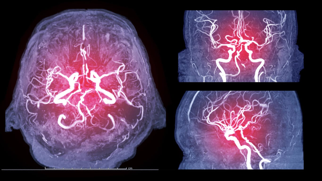 Aufnahmen des Gehirns: Unter den schweren Covid-19-Verläufen seien laut Experten häufig vorerkrankte Menschen, etwa mit Diabetes und hohem Blutdruck.