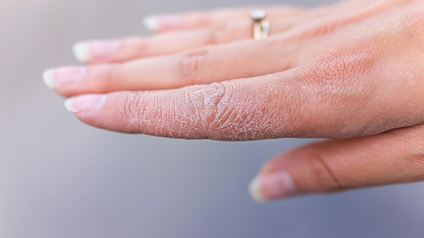 Hände: Häufiges Desinfizieren macht die Haut trocken und rissig.