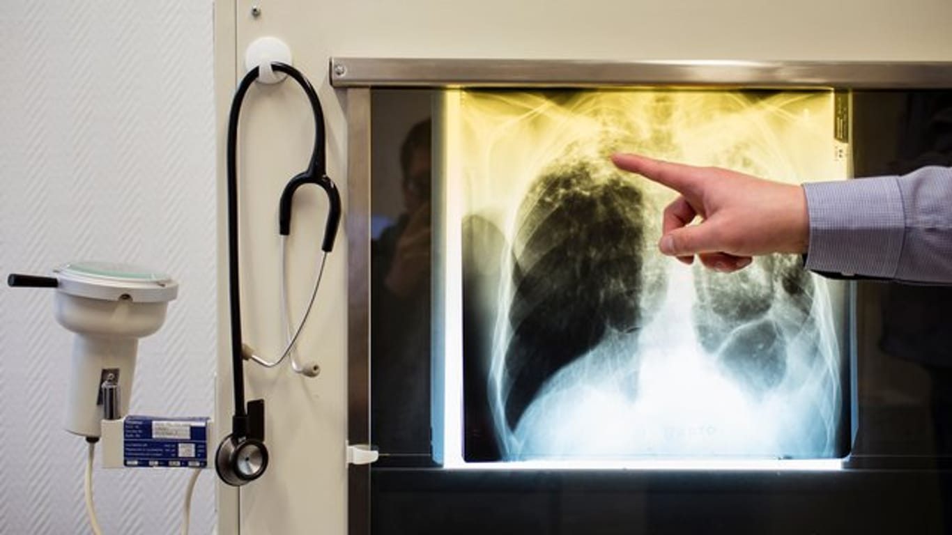 Ein Arzt zeigt einen Tuberkulose-Fall anhand eines Röntgenbildes