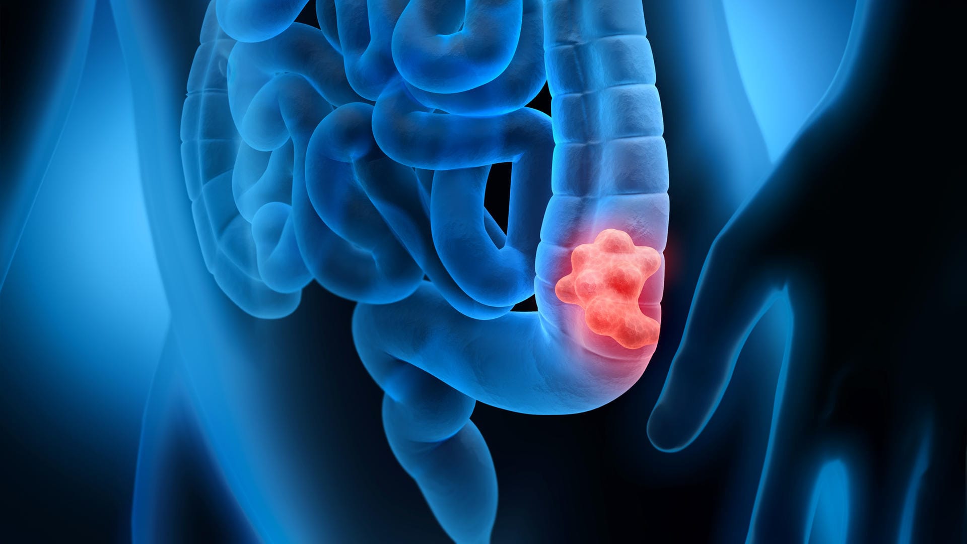 3d-Grafik eines Darms mit Tumorbefall: Durch Vorsorge und einen gesunden Lebensstil lässt sich das Darmkrebsrisiko stark senken.