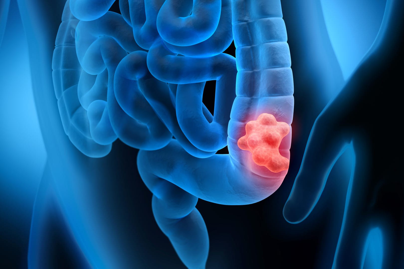 3d-Grafik eines Darms mit Tumorbefall: Durch Vorsorge und einen gesunden Lebensstil lässt sich das Darmkrebsrisiko stark senken.