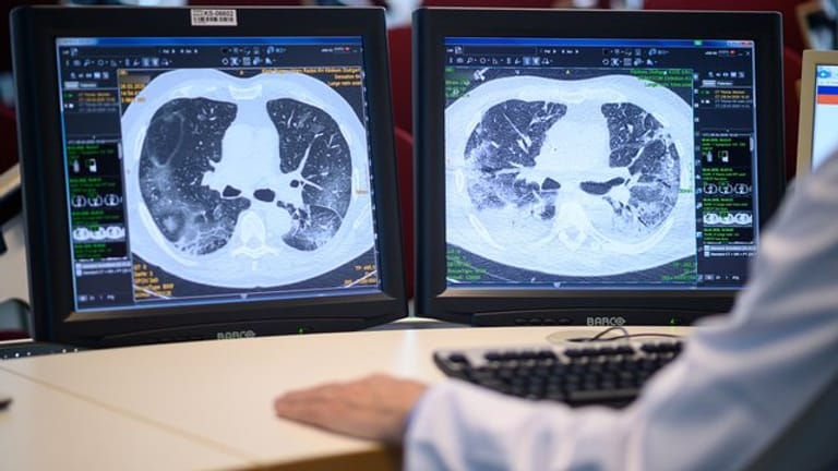 Auf zwei Monitoren sind am Klinikum Stuttgart Computertomographieaufnahmen der Lunge eines Covid-19-Patienten zu sehen.