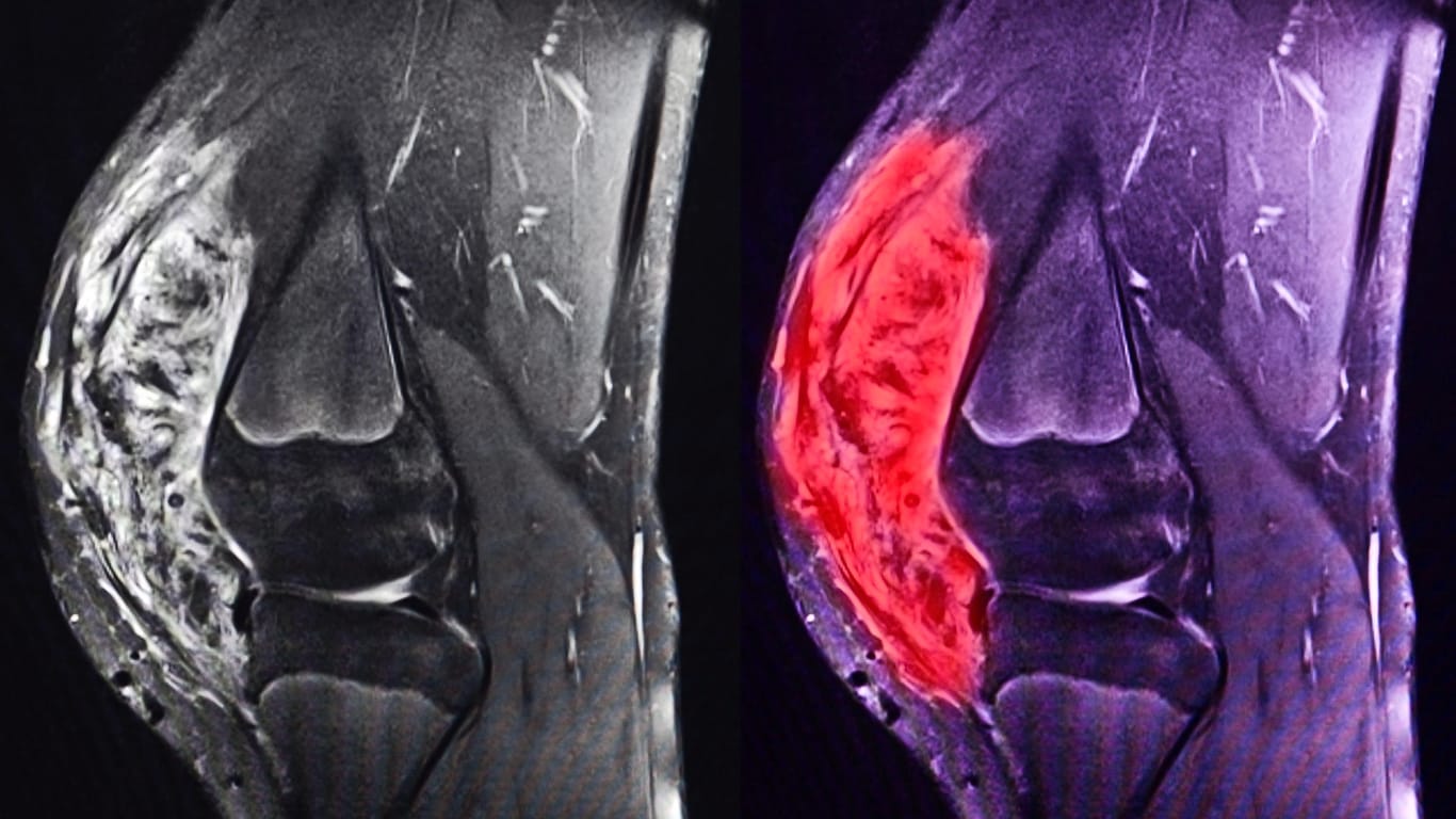 Magnetresonanztomografische Darstellung des Knies: Die rote Einfärbung zeigt ein ausgeprägtes Sarkom.