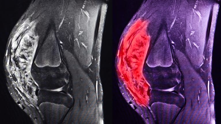 Magnetresonanztomografische Darstellung des Knies: Die rote Einfärbung zeigt ein ausgeprägtes Sarkom.