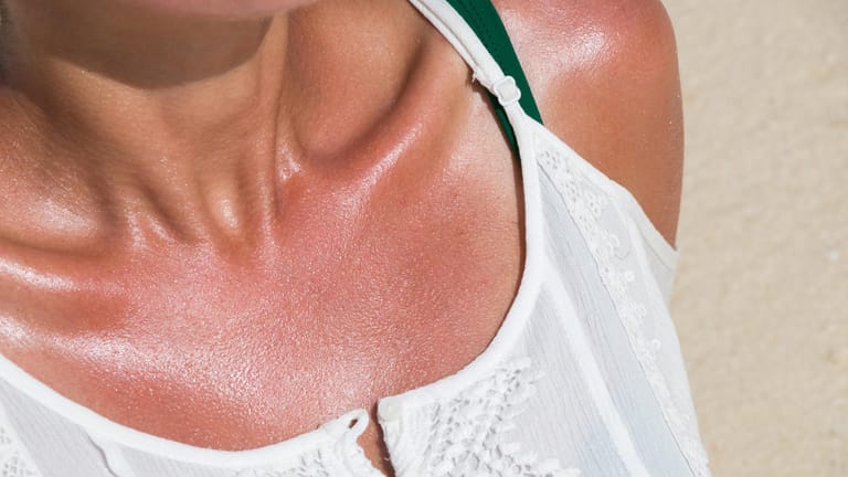 Sonnenbrand: Einige Medikamente können die Haut lichtempfindlich machen und sorgen so für ein schnelleres Verbrennen in der Sonne.