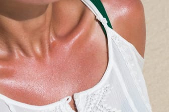 Sonnenbrand: Einige Medikamente können die Haut lichtempfindlich machen und sorgen so für ein schnelleres Verbrennen in der Sonne.