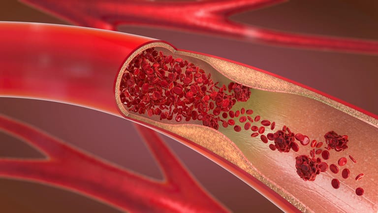 Abbildung einer verengten Arterie: Nach Infektionen können sich gefährliche Blutgerinnsel bilden.