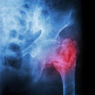 Knochenbruch: In Deutschland erleiden jedes Jahr rund 120.000 Menschen einen Oberschenkelbruch.