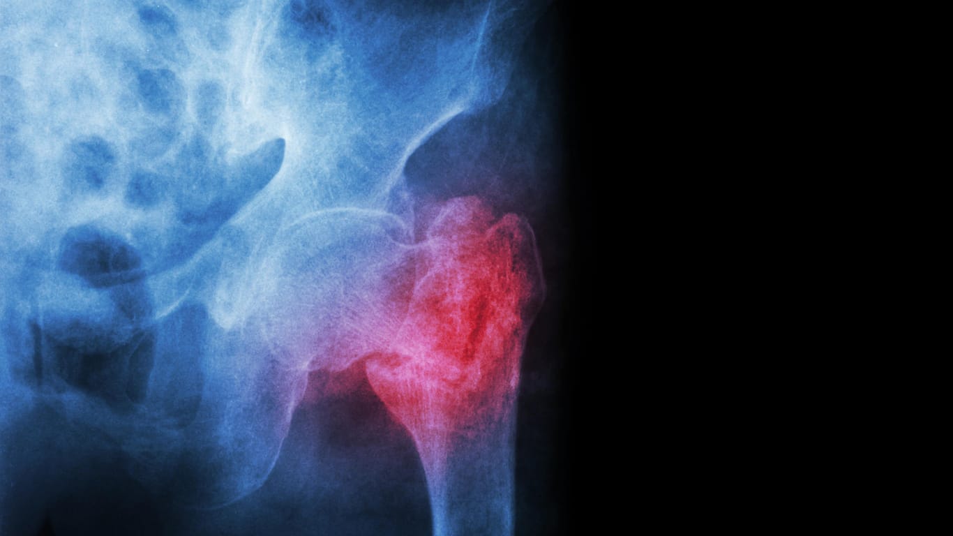 Knochenbruch: In Deutschland erleiden jedes Jahr rund 120.000 Menschen einen Oberschenkelbruch.