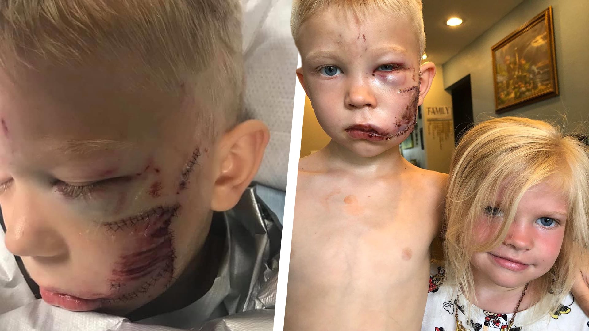 Spuren der heldenhaften Tat: Der sechsjährige Bridger stellte sich zwischen einen Hund und seine Schwester und wird dafür von den "Avengers"-Stars gefeiert. Spuren der heldenhaften Tat: Der sechsjährige Bridger stellte sich zwischen einen Hund und seine Schwester und wird dafür von den "Avengers"-Stars gefeiert.