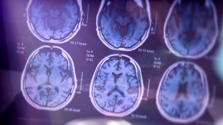 Gehirnscan: Neuere Studien und Fallberichte beschreiben zunehmend Auswirkungen von Covid-19 auf das Gehirn.