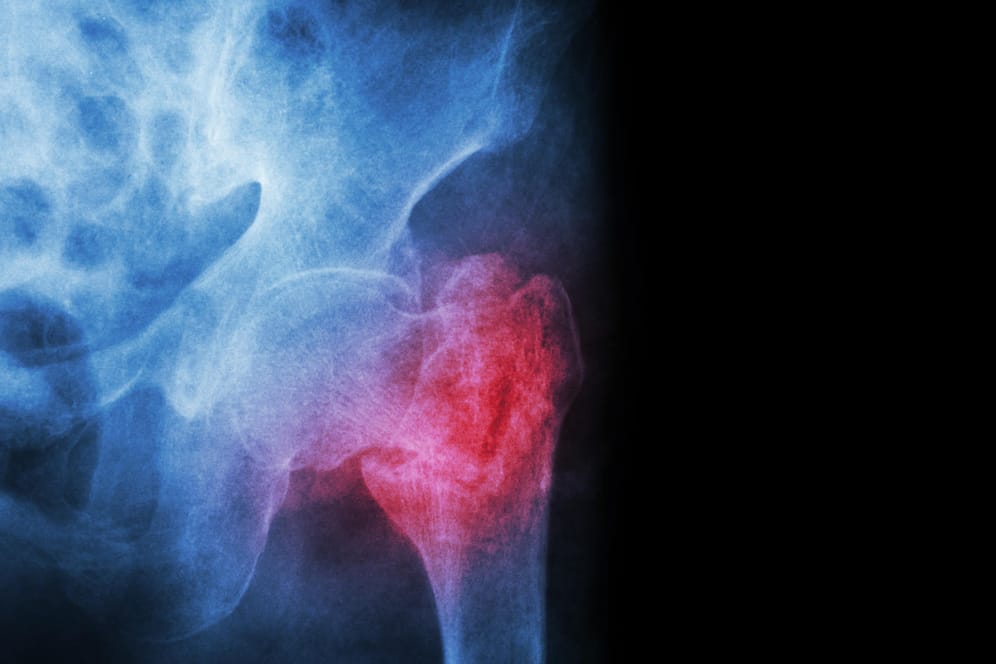 Röntgenaufnahme einer Fraktur im linken Hüftknochen. Knochenbrüche dieser Art treten häufig infolge von Osteoporose auf.