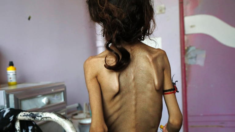 Ein Kind in Jemens Hauptstadt Sanaa: Viele Menschen in dem krisengeschüttelten Land leiden Hunger, der Hilfebedarf ist enorm.