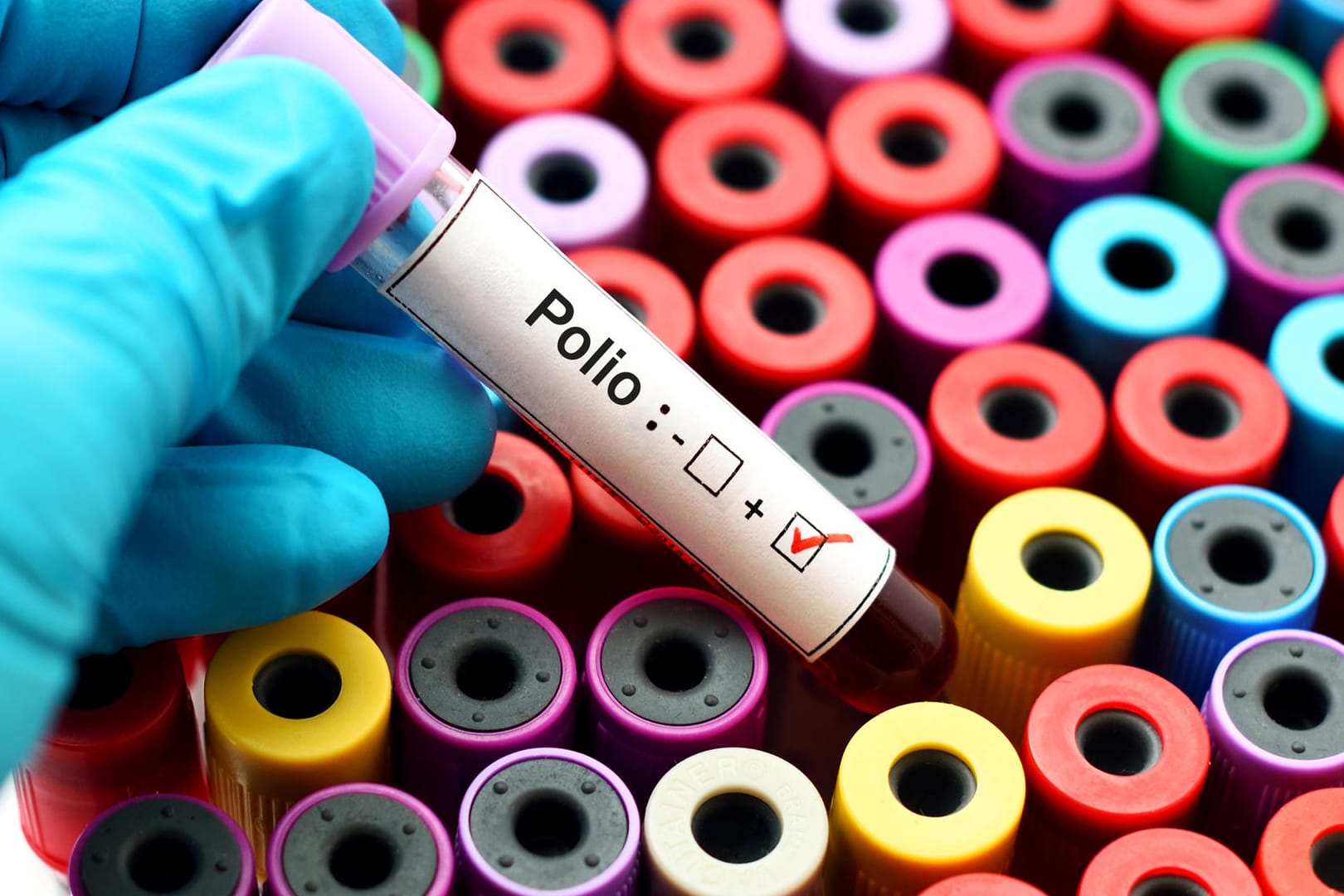 Polio: Dier Erkrankung kann zu bleibenden Lähmungen führen.
