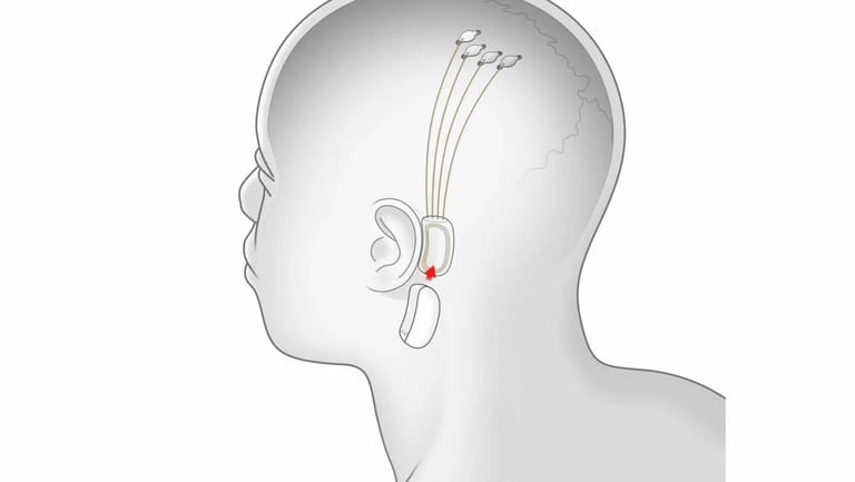 Neuralink-Grafik seines Geräts: Das Unternehmen will eine Verbindung zwischen Hirn und Maschine herstellen