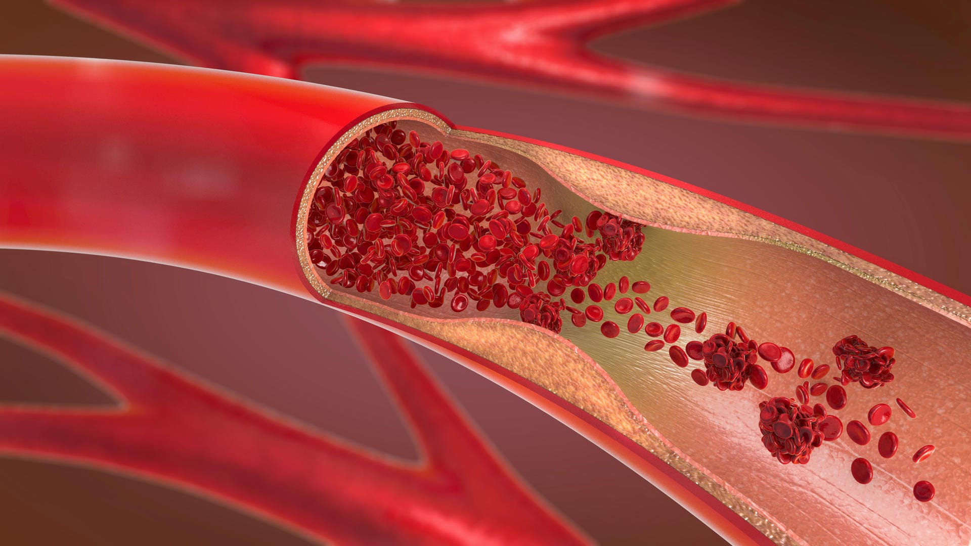 Ablagerungen in der Arterie: Menschen ab 65 Jahren mit bestimmten Risikofaktoren sollten ihre Halsschlagader jährlich kontrollieren lassen.