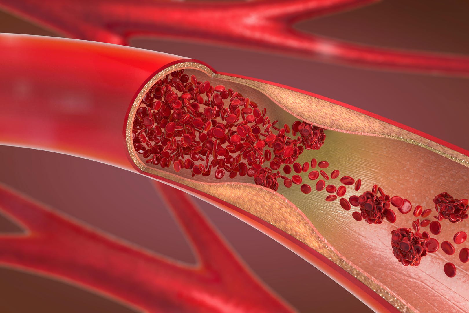 Ablagerungen in der Arterie: Menschen ab 65 Jahren mit bestimmten Risikofaktoren sollten ihre Halsschlagader jährlich kontrollieren lassen.