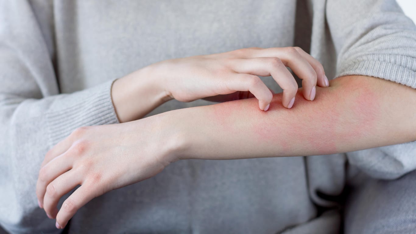 Hautausschlag: Hausstaub-Allergiker sollten ihre Bettwäsche regelmäßig reinigen.