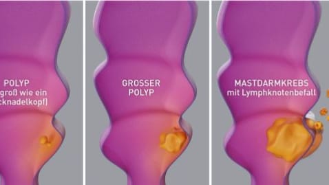 Vom Darmpolypen zum Darmkrebs: 90 Prozent aller Darmkrebserkrankungen entstehen aus gutartigen Polypen in der Darmschleimhaut. Im Laufe der Jahre werden sie durch Genveränderungen bösartig und entwickeln sich zu einem Karzinom, das im fortgeschrittenen Stadium Metastasen bildet.
