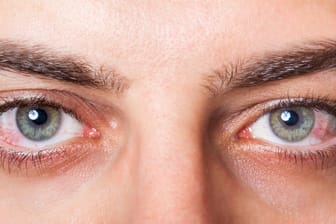 Gerötete Augen: Eine Hornhaut- oder Bindehautentzündung könnte dahinterstecken.