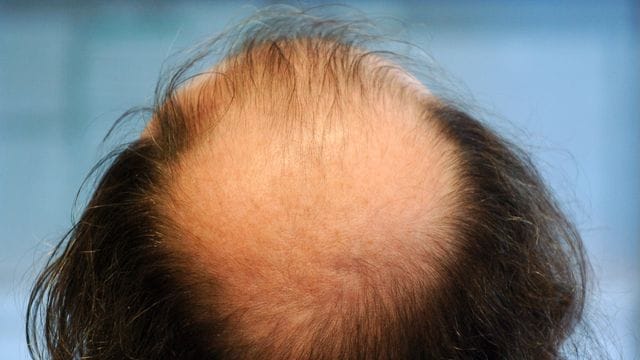 Schreck eines jeden Mannes: Haarausfall.