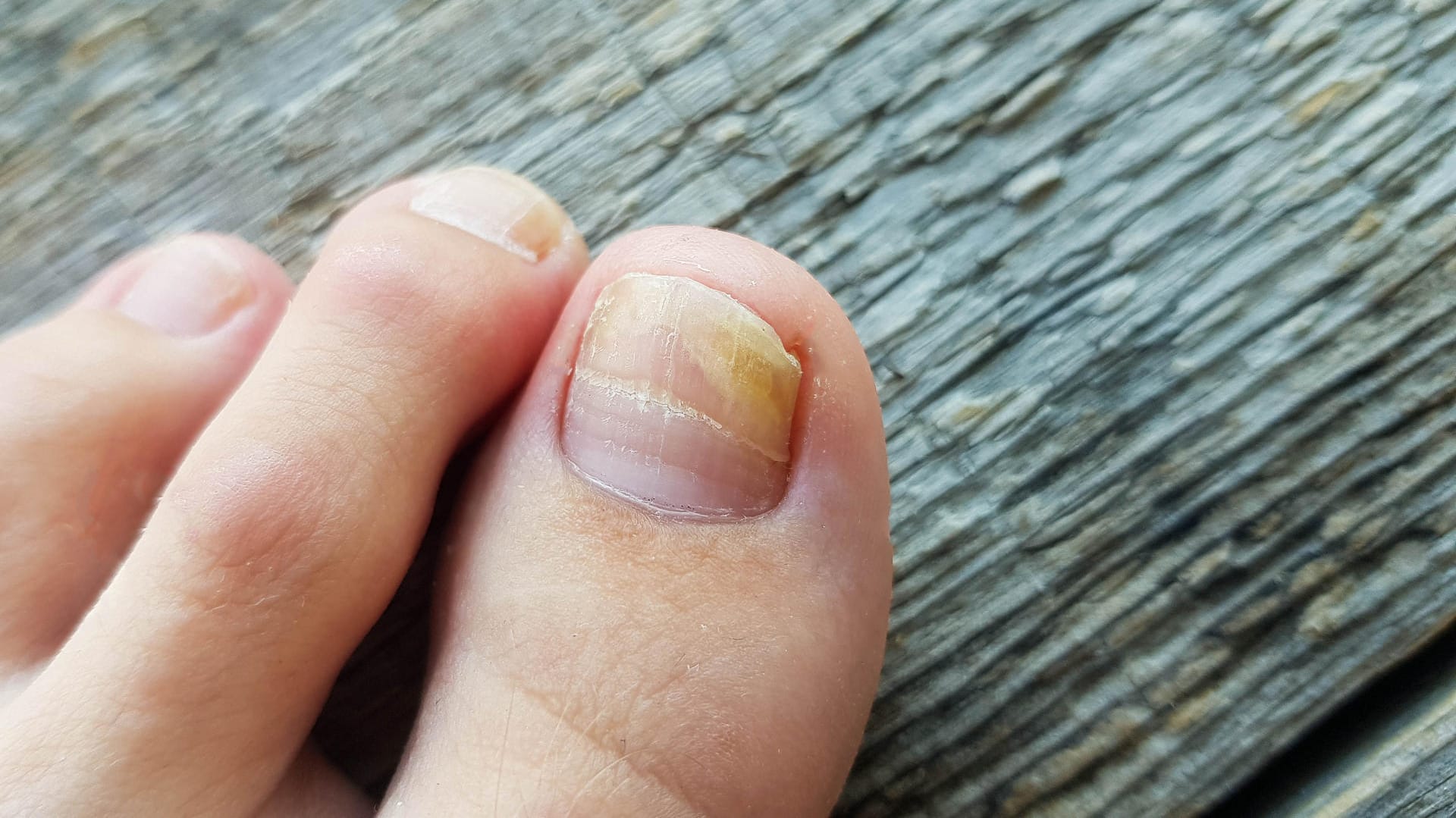 Nagelveränderungen durch Nagelpilz: Fast immer dringen die Erreger am freien vorderen oder seitlichen Nagelrand ein.