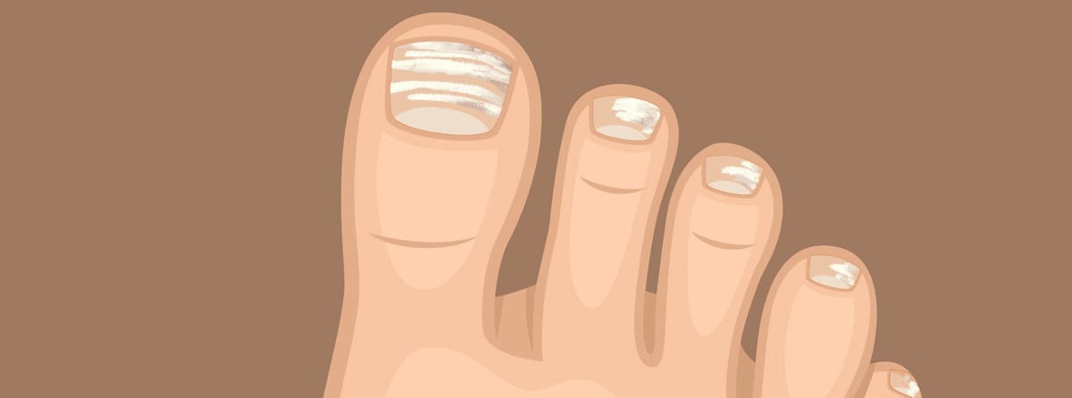 Weißer Nagelpilz: Typisch sind die weißen Verfärbungen der Nägel