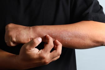 Hautausschlag: Bestimmte Symptome auf der Haut können in Verbindung mit einer Covid-19-Erkrankung stehen.