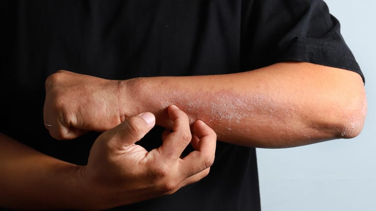 Hautausschlag: Bestimmte Symptome auf der Haut können in Verbindung mit einer Covid-19-Erkrankung stehen.