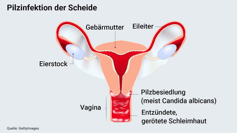 Weibliches Geschlechtsorgan: Bei einem Vaginalpilz ist die Scheidenschleimhaut entzündet.