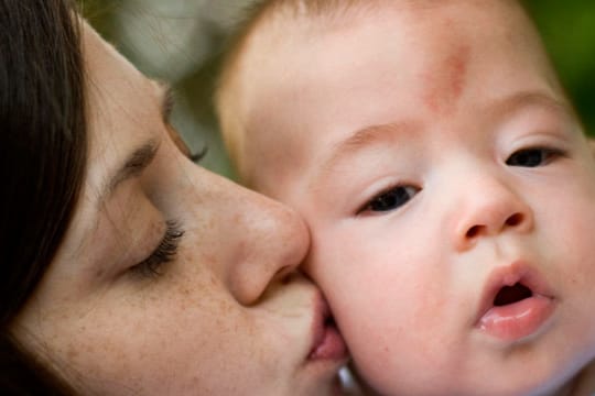 Storchenbiss beim Baby: Ein Storchenbiss, wie hier auf der Stirn des Babys, verschwindet meistens von selbst.