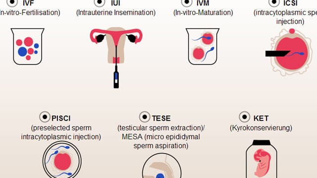 Künstliche Befruchtung: Interaktive Grafik zeigt die unterschiedlichen Methoden der künstlichen Befruchtung.