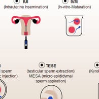 Künstliche Befruchtung: Interaktive Grafik zeigt die unterschiedlichen Methoden der künstlichen Befruchtung.